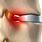 hernia cervical almohada