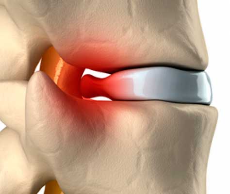 hernia cervical almohada