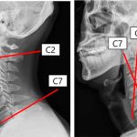 Lordosis Cervical