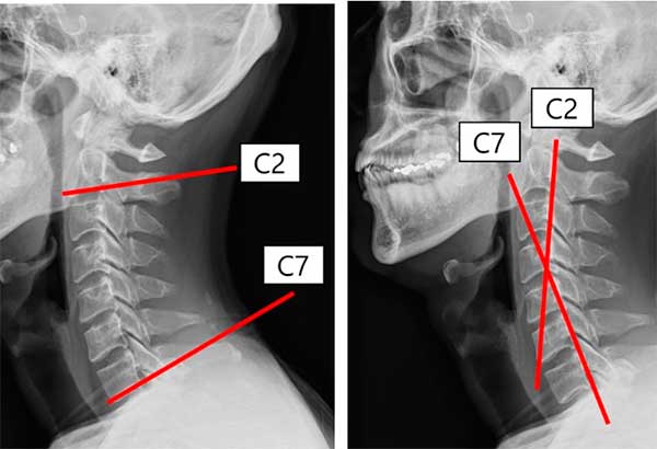 Lordosis Cervical